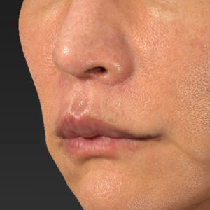 新宿ラクル美容外科クリニック　山本厚志　「人中短縮術（リップリフト）＋口角挙上（スマイルリップ）」　手術後３ヶ月目　８月２０日