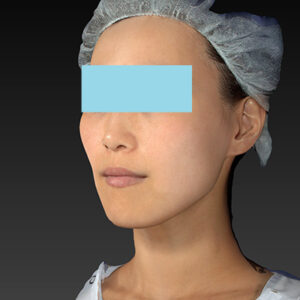 新宿ラクル美容外科クリニック　山本厚志　「アルテミスリフト」　手術後３ヶ月目　９月７日