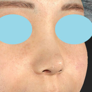 「耳介軟骨移植＋鼻尖縮小（close法）＋小鼻縮小+α」　新宿ラクル美容外科クリニック　２０代女性　手術後６ヶ月目　９月２６日