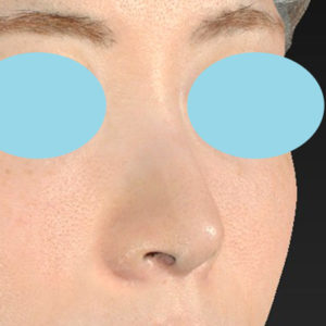 新宿ラクル美容外科クリニック　山本厚志　「小鼻縮小+α法 ＋ 鼻孔縁下降術」　手術後６ヶ月目　８月１２日