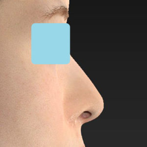 新宿ラクル美容外科クリニック　山本厚志　「小鼻縮小+α法 ＋ 鼻孔縁下降術」　手術前　８月１２日