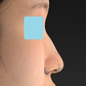 「小鼻縮小+α＋鼻尖縮小（close法）」　新宿ラクル美容外科クリニック　２０代女性　デザイン　８月１９日