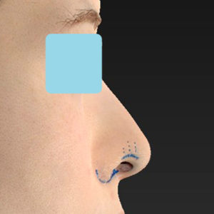 新宿ラクル美容外科クリニック　山本厚志　「小鼻縮小+α法 ＋ 鼻孔縁下降術」　デザイン　８月１２日