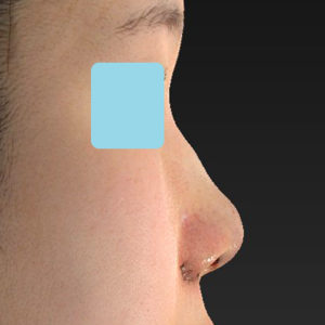 「小鼻縮小+α＋鼻尖縮小（close法）」　新宿ラクル美容外科クリニック　２０代女性　手術直後　８月１９日