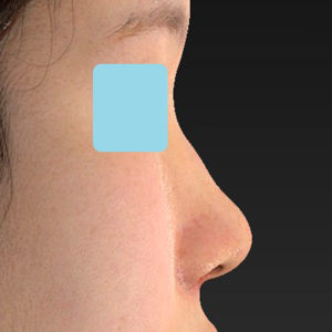 「小鼻縮小+α＋鼻尖縮小（close法）」　新宿ラクル美容外科クリニック　２０代女性　手術後１週間目　８月１９日