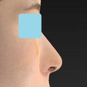 新宿ラクル美容外科クリニック　山本厚志　「小鼻縮小+α法 ＋ 鼻孔縁下降術」　手術後１週間目　８月１２日