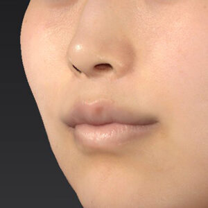 新宿ラクル美容外科クリニック　山本厚志　「猫手術（鼻唇角形成術）+ 貴族手術（鼻翼基部プロテーゼ）+ 口角挙上（スマイルリフト）+ 人中短縮術（リップリフト）」　手術後１２ヶ月目　２月１６日