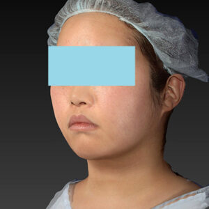 新宿ラクル美容外科クリニック　山本厚志　「ライポライフ脂肪吸引（ジョールファット+あご下）」　手術後１２ヶ月目　２月２１日