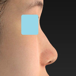 「小鼻縮小+α＋鼻尖縮小（close法）」　新宿ラクル美容外科クリニック　２０代女性　手術後１ヶ月目　８月１９日