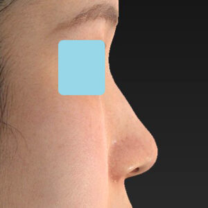 「小鼻縮小+α＋鼻尖縮小（close法）」　新宿ラクル美容外科クリニック　２０代女性　手術後３ヶ月目　９月１２日