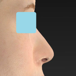 新宿ラクル美容外科クリニック　山本厚志　「小鼻縮小+α法 ＋ 鼻孔縁下降術」　手術後３ヶ月目　８月１２日