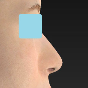 新宿ラクル美容外科クリニック　山本厚志　「小鼻縮小+α法 ＋ 鼻孔縁下降術」　手術後６ヶ月目　８月１２日