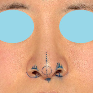 「鼻孔縁下降術＋小鼻縮小＋α法＋耳介軟骨移植＋鼻尖縮小（close法）＋真皮脂肪移植＋猫手術」　新宿ラクル美容外科クリニック　山本厚志　２０代女性　デザイン　９月１９日