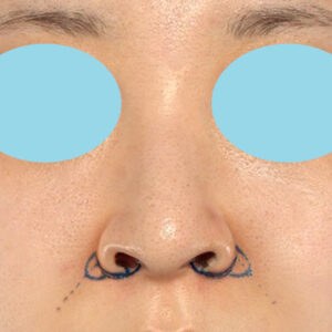 新宿ラクル美容外科クリニック　山本厚志　「貴族手術（鼻翼基部プロテーゼ）＋ 小鼻縮小+α法」　デザイン　９月２８日