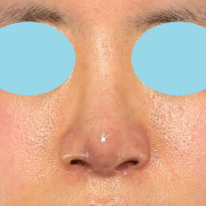 「鼻孔縁下降術＋小鼻縮小＋α法＋耳介軟骨移植＋鼻尖縮小（close法）＋真皮脂肪移植＋猫手術」　新宿ラクル美容外科クリニック　山本厚志　２０代女性　手術後１週間目　９月１９日