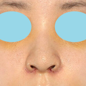 新宿ラクル美容外科クリニック　山本厚志　「貴族手術（鼻翼基部プロテーゼ）＋ 小鼻縮小+α法」　手術後１週間目　９月２８日