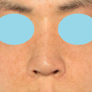 「鼻孔縁下降術」　新宿ラクル美容外科クリニック　山本厚志　２０代女性　手術後１２ヶ月目　３月８日