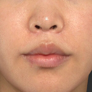 新宿ラクル美容外科クリニック　山本厚志　「人中短縮術（リップリフト）＋口角挙上（スマイルリップ）」　手術後１２ヶ月目　４月３日