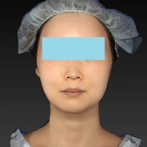 新宿ラクル美容外科クリニック　山本厚志　「アルテミスリフト」　手術後１２ヶ月目　４月１６日