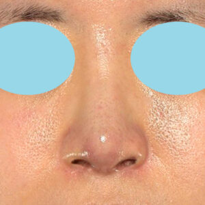 「鼻孔縁下降術＋小鼻縮小＋α法＋耳介軟骨移植＋鼻尖縮小（close法）＋真皮脂肪移植＋猫手術」　新宿ラクル美容外科クリニック　山本厚志　２０代女性　手術後１ヶ月目　９月１９日