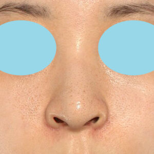 新宿ラクル美容外科クリニック　山本厚志　「貴族手術（鼻翼基部プロテーゼ）＋ 小鼻縮小+α法」　手術後１ヶ月目　９月２８日