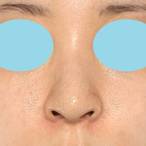 新宿ラクル美容外科クリニック　山本厚志　「貴族手術（鼻翼基部プロテーゼ）＋ 小鼻縮小+α法」　手術後２ヶ月目　９月２８日