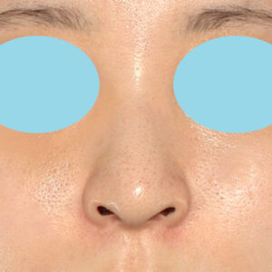 新宿ラクル美容外科クリニック　山本厚志　「貴族手術（鼻翼基部プロテーゼ）＋ 小鼻縮小+α法」　手術後３ヶ月目　１０月１０日