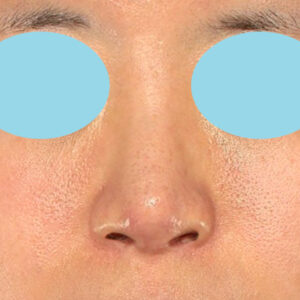 「鼻孔縁下降術＋小鼻縮小＋α法＋耳介軟骨移植＋鼻尖縮小（close法）＋真皮脂肪移植＋猫手術」　新宿ラクル美容外科クリニック　山本厚志　２０代女性　手術後６ヶ月目　９月１９日