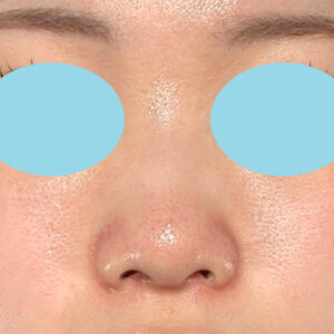 「小鼻縮小+α＋鼻尖縮小（close法）」　新宿ラクル美容外科クリニック　２０代女性　手術後６ヶ月目　１２月６日