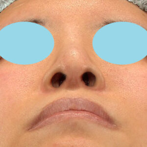 「鼻孔縁下降術＋小鼻縮小＋α法＋耳介軟骨移植＋鼻尖縮小（close法）＋真皮脂肪移植＋猫手術」　新宿ラクル美容外科クリニック　山本厚志　２０代女性　手術前　９月１９日