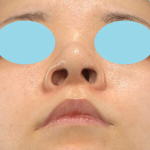 新宿ラクル美容外科クリニック　山本厚志　「貴族手術（鼻翼基部プロテーゼ）＋ 小鼻縮小+α法」　手術前　９月２８日