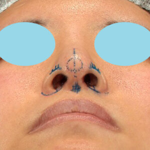 「鼻孔縁下降術＋小鼻縮小＋α法＋耳介軟骨移植＋鼻尖縮小（close法）＋真皮脂肪移植＋猫手術」　新宿ラクル美容外科クリニック　山本厚志　２０代女性　デザイン　９月１９日