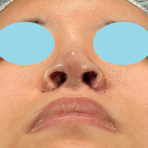「鼻孔縁下降術＋小鼻縮小＋α法＋耳介軟骨移植＋鼻尖縮小（close法）＋真皮脂肪移植＋猫手術」　新宿ラクル美容外科クリニック　山本厚志　２０代女性　手術直後　９月１９日