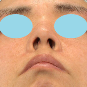 「鼻孔縁下降術」　新宿ラクル美容外科クリニック　山本厚志　２０代女性　手術後１２ヶ月目　３月８日