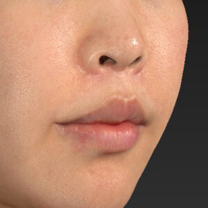 新宿ラクル美容外科クリニック　山本厚志　「人中短縮術（リップリフト）＋口角挙上（スマイルリップ）」　手術後１２ヶ月目　４月３日