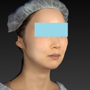 新宿ラクル美容外科クリニック　山本厚志　「アルテミスリフト」　手術後１２ヶ月目　４月１６日