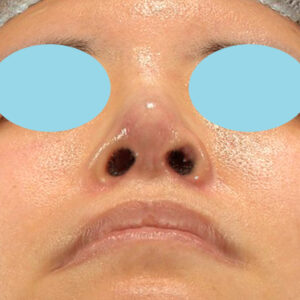 「鼻孔縁下降術＋小鼻縮小＋α法＋耳介軟骨移植＋鼻尖縮小（close法）＋真皮脂肪移植＋猫手術」　新宿ラクル美容外科クリニック　山本厚志　２０代女性　手術後１ヶ月目　９月１９日