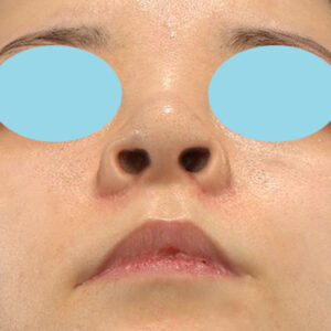 新宿ラクル美容外科クリニック　山本厚志　「貴族手術（鼻翼基部プロテーゼ）＋ 小鼻縮小+α法」　手術後１ヶ月目　９月２８日