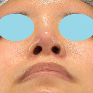「鼻孔縁下降術＋小鼻縮小＋α法＋耳介軟骨移植＋鼻尖縮小（close法）＋真皮脂肪移植＋猫手術」　新宿ラクル美容外科クリニック　山本厚志　２０代女性　手術後２ヶ月目　９月１９日