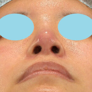 「鼻孔縁下降術＋小鼻縮小＋α法＋耳介軟骨移植＋鼻尖縮小（close法）＋真皮脂肪移植＋猫手術」　新宿ラクル美容外科クリニック　山本厚志　２０代女性　手術後３ヶ月目　９月１９日