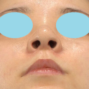 新宿ラクル美容外科クリニック　山本厚志　「貴族手術（鼻翼基部プロテーゼ）＋ 小鼻縮小+α法」　手術後３ヶ月目　１０月１０日