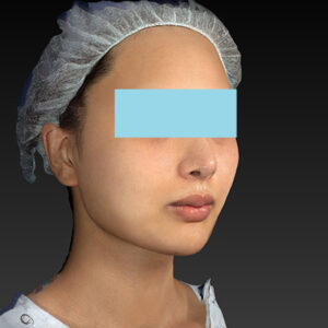 新宿ラクル美容外科クリニック　山本厚志　「アルテミスリフト＋ライポライフ脂肪吸引（メーラーファット+ジョールファット）」　手術後６ヶ月目　１１月２７日