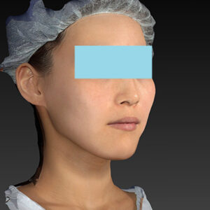 新宿ラクル美容外科クリニック　山本厚志　「アルテミスリフト」　手術後６ヶ月目　１２月８日