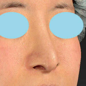 「鼻孔縁下降術＋小鼻縮小＋α法＋耳介軟骨移植＋鼻尖縮小（close法）＋真皮脂肪移植＋猫手術」　新宿ラクル美容外科クリニック　山本厚志　２０代女性　手術前　９月１９日