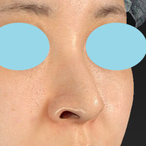 新宿ラクル美容外科クリニック　山本厚志　「貴族手術（鼻翼基部プロテーゼ）＋ 小鼻縮小+α法」　手術前　９月２８日