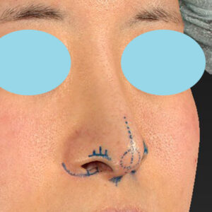 「鼻孔縁下降術＋小鼻縮小＋α法＋耳介軟骨移植＋鼻尖縮小（close法）＋真皮脂肪移植＋猫手術」　新宿ラクル美容外科クリニック　山本厚志　２０代女性　デザイン　９月１９日