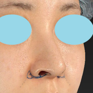 新宿ラクル美容外科クリニック　山本厚志　「貴族手術（鼻翼基部プロテーゼ）＋ 小鼻縮小+α法」　デザイン　９月２８日