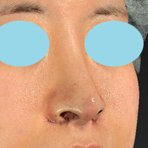 「鼻孔縁下降術＋小鼻縮小＋α法＋耳介軟骨移植＋鼻尖縮小（close法）＋真皮脂肪移植＋猫手術」　新宿ラクル美容外科クリニック　山本厚志　２０代女性　手術直後　９月１９日