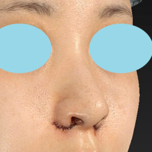 新宿ラクル美容外科クリニック　山本厚志　「貴族手術（鼻翼基部プロテーゼ）＋ 小鼻縮小+α法」　手術直後　９月２８日