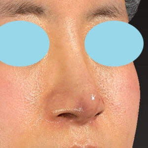 「鼻孔縁下降術＋小鼻縮小＋α法＋耳介軟骨移植＋鼻尖縮小（close法）＋真皮脂肪移植＋猫手術」　新宿ラクル美容外科クリニック　山本厚志　２０代女性　手術後１週間目　９月１９日